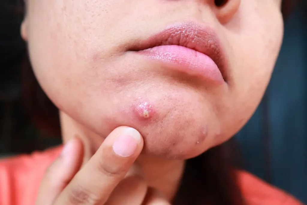 A woman gently removing pustules and whitehead acne from her face, addressing acne and scars on her skin.